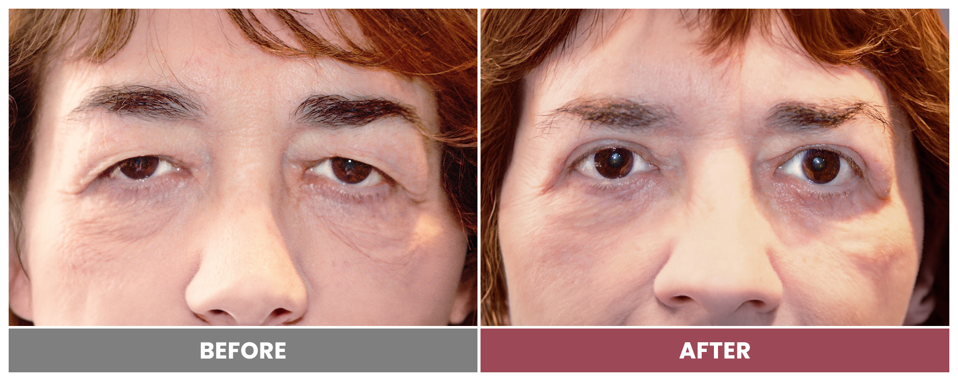 Upper Blepharoplasty - Case 47